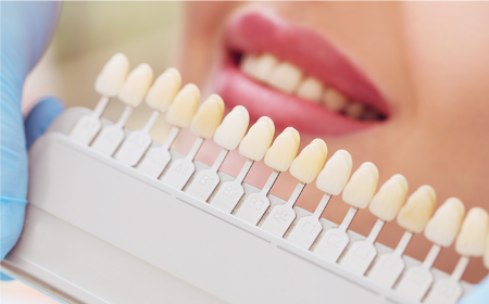 Cerec crowns in a day