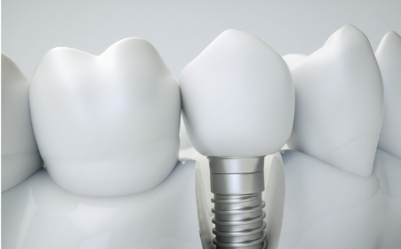 In-house Implants
